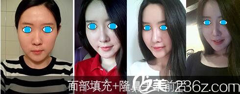 濟(jì)源萍面部填充和隆鼻案例 濟(jì)源萍面部填充和隆鼻案例