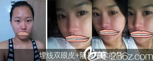濟(jì)源萍雙眼皮和隆鼻案例 濟(jì)源萍雙眼皮和隆鼻案例
