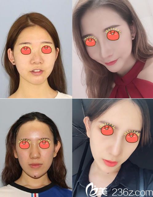 寧波薇琳張廣巍鼻綜合案例 寧波薇琳張廣巍鼻綜合案例