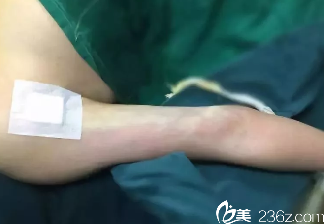 吸脂瘦手臂術(shù)后即刻 吸脂瘦手臂術(shù)后即刻