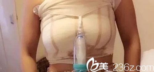 假體隆胸后4天 假體隆胸后4天