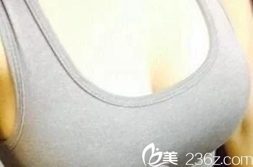 假體隆胸手術(shù)一個半月效果圖 假體隆胸手術(shù)一個半月效果圖