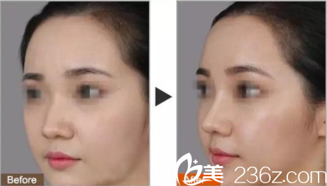衡陽美萊隆鼻前后對比照片