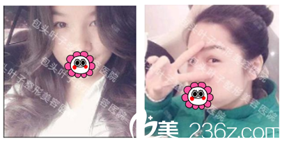 包頭葉子整形埋線雙眼皮案例 包頭葉子整形埋線雙眼皮案例
