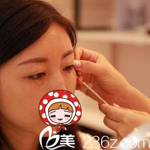 做內(nèi)切祛眼袋術(shù)前面診