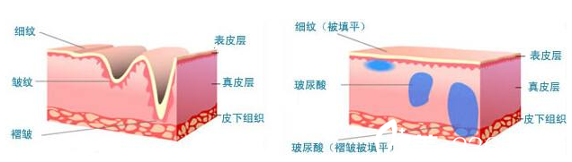 玻尿酸注射原理 玻尿酸注射原理