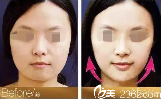 線雕提拉前后對比