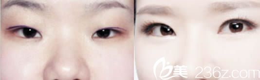 北京美萊整形美容醫(yī)院劉金華眼綜合手術(shù)效果對比圖