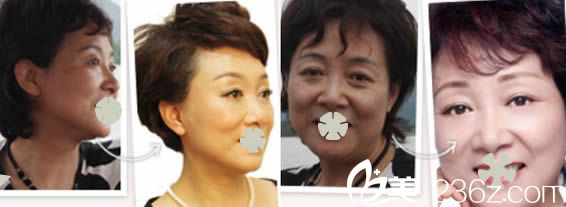 北京美萊向淑英醫(yī)生注射美膚效果對比圖