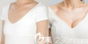 北京聯(lián)合麗格田孝臣胸部整形案例