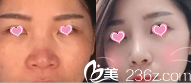 北京聯(lián)合麗格田孝臣鼻綜合案例