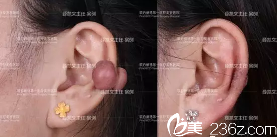 北京聯(lián)合麗格薛凱文去疤痕疙瘩案例