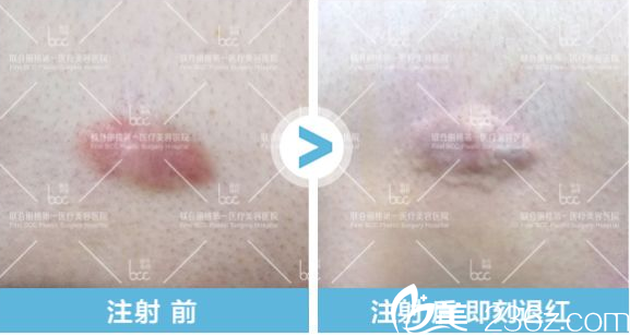 北京聯(lián)合麗格薛凱文疤痕針注射前后效果