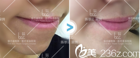 北京聯(lián)合麗格陳翠云玻尿酸豐下巴案例 北京聯(lián)合麗格陳翠云玻尿酸豐下巴案例