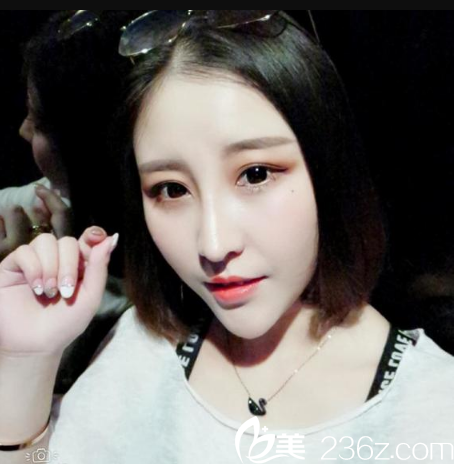 在深圳軍科整形醫(yī)院做完鼻子兩個(gè)月效果圖 在深圳軍科整形醫(yī)院做完鼻子兩個(gè)月效果圖