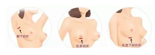 假體豐胸的手術(shù)切口