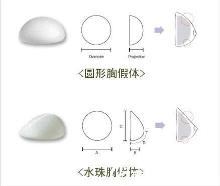 豐胸假體也分不同的形狀