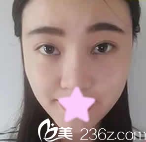 看了我在大同美神整形打瘦臉前后對(duì)比照片，大家感覺(jué)這效果怎么樣