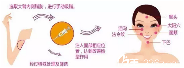 自體脂肪填充法令紋除皺