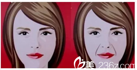 玻尿酸填充法令紋