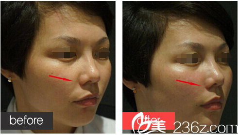 填充法令紋除皺前后對比