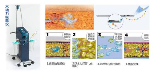 水動力吸脂過程