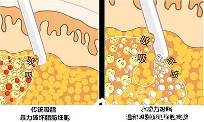 水動力吸脂優(yōu)勢