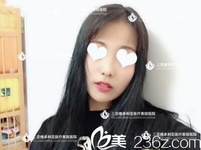 做自體脂肪面部填充術(shù)前照 做自體脂肪面部填充術(shù)前照