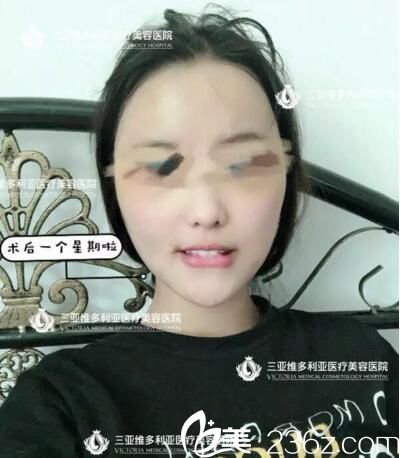 自體脂肪面部填充術(shù)后一星期<span style= 自體脂肪面部填充術(shù)后一星期<span style=