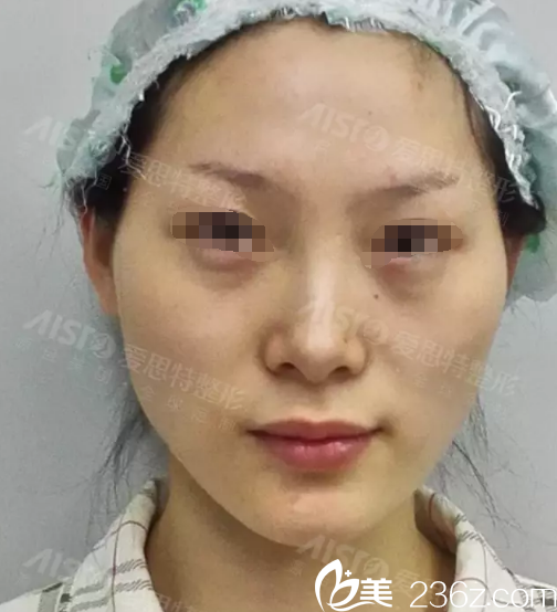 術(shù)前面部凹陷嚴重 術(shù)前面部凹陷嚴重