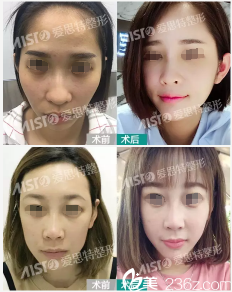 程寧新院長脂肪填充案例 程寧新院長脂肪填充案例