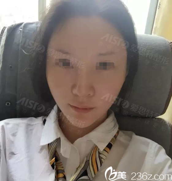 脂肪填充術(shù)后三天恢復 脂肪填充術(shù)后三天恢復