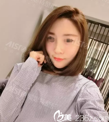 五天后自體脂肪填充恢復 五天后自體脂肪填充恢復