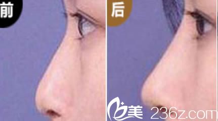 長沙愛思特整形假體隆鼻效果對比圖