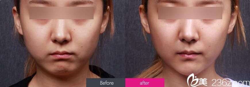 武漢亞韓硅膠假體墊下巴前后對(duì)比案例