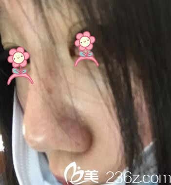 鄭州麗天玻尿酸注射隆鼻術(shù)后2天 鄭州麗天玻尿酸注射隆鼻術(shù)后2天