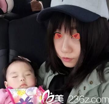 鄭州麗天玻尿酸注射隆鼻術(shù)后31天 鄭州麗天玻尿酸注射隆鼻術(shù)后31天