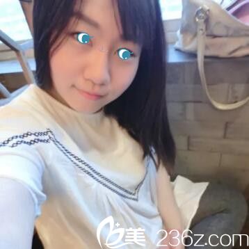 鄭州麗天玻尿酸注射隆鼻術(shù)后36天 鄭州麗天玻尿酸注射隆鼻術(shù)后36天