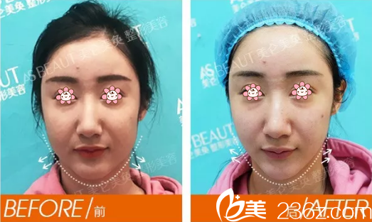 晟晟全面部線雕術(shù)前術(shù)后對比