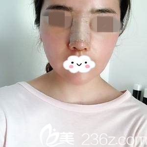 術后第三天 術后第三天