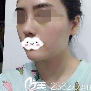 肋軟骨隆鼻半個月 肋軟骨隆鼻半個月