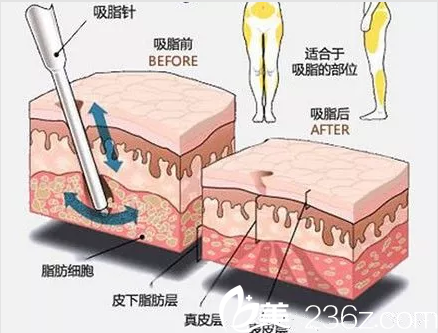 吸脂示意圖