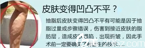 吸脂后皮膚凹凸不平展示圖