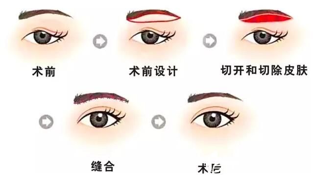 提眉手術(shù)的基本原理