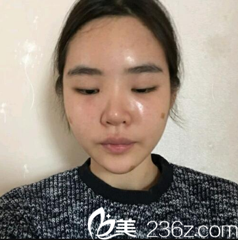 廣州曙光自體脂肪填充術(shù)后三天