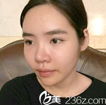 廣州曙光自體脂肪填充術(shù)后7天效果