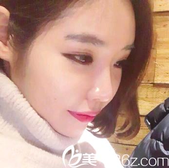 自體脂肪填充全臉術(shù)后15天自拍