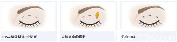 韓式三點定位雙眼皮能維持多久