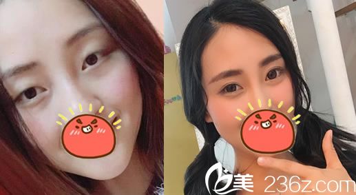 杭州維多利亞馬康割雙眼皮案例