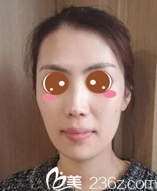 玻尿酸隆鼻+自體脂肪填充面部術(shù)前照 玻尿酸隆鼻+自體脂肪填充面部術(shù)前照